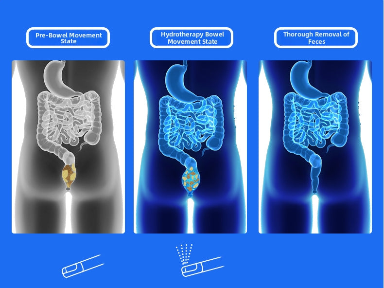 detailed diagram showing how the 828 square enema smart bidet toilet helps to solve constipation by softening hard stool for an effortless bowel movement